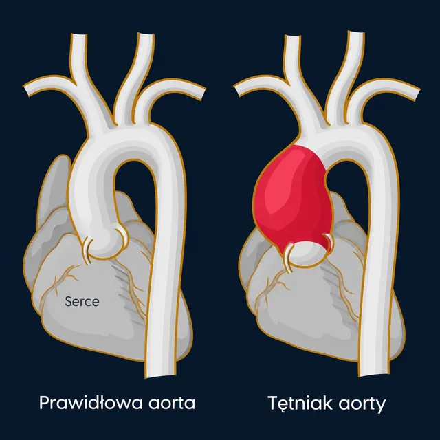 Prawidłowa aorta i tętniak aorty wstępującej